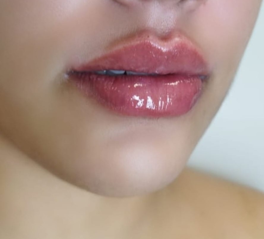 Registro de resultado individual de preenchimento labial, sem imagem de antes pareada