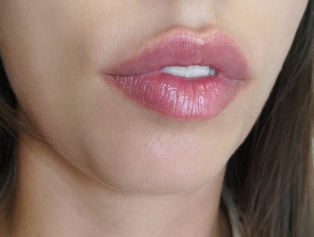 Registro de resultado individual de preenchimento labial, sem imagem de antes pareada