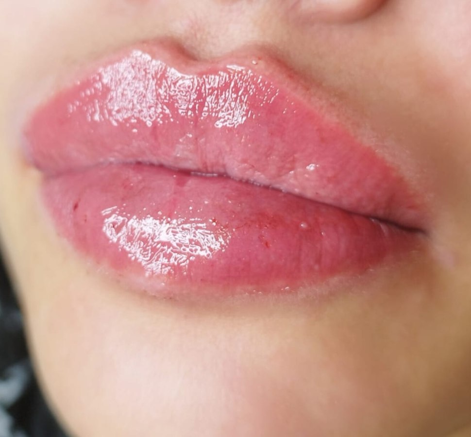Registro de resultado individual de preenchimento labial, sem imagem de antes pareada