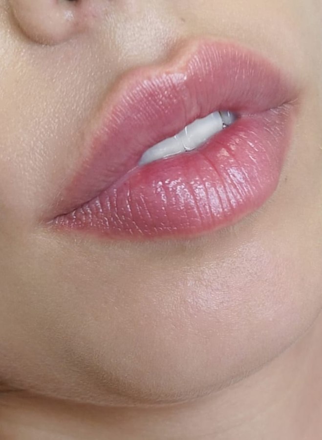 Registro de resultado individual de preenchimento labial, sem imagem de antes pareada