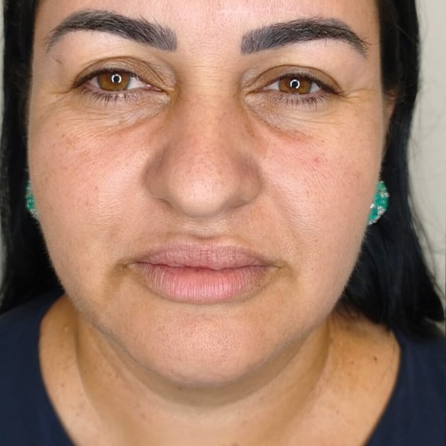 Reestruturação facial — antes